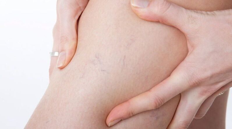 Signos de venas varicosas en las piernas de una mujer - arañas vasculares