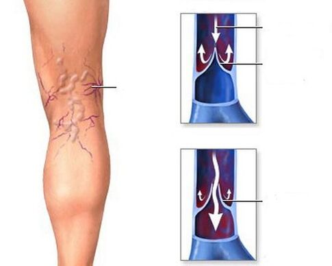 consecuencias de las venas varicosas de las piernas